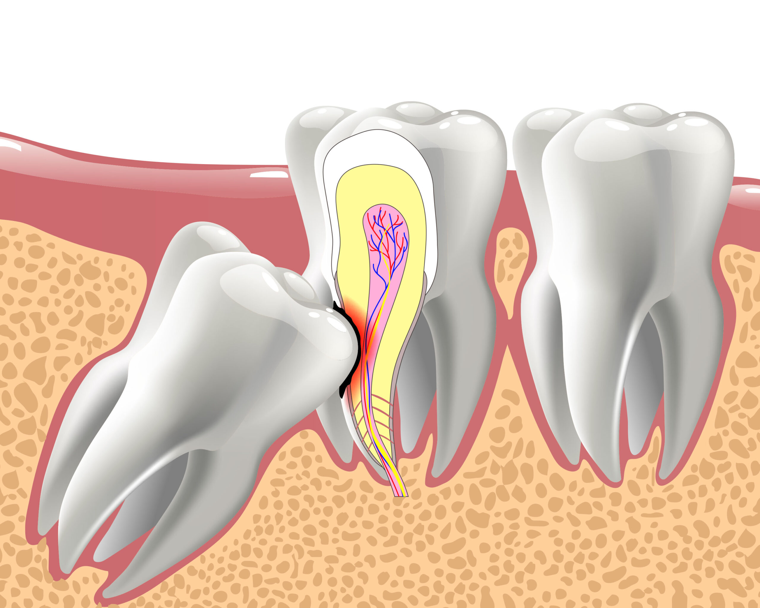 wisdom teeth removal Enmore